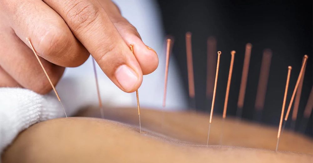 Holistic health practitioner administers acupuncture by placing fine needles beneath the skin of their patient